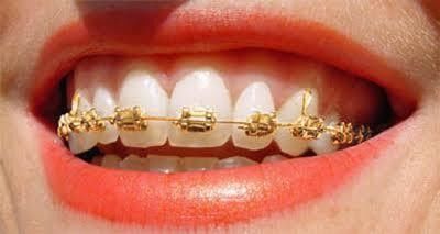 0.022/0.018 Schlitzgröße DTC Orthodontische Zahnbehandlung Goldbeschichtete Klammern Klammer Ortho Stoff