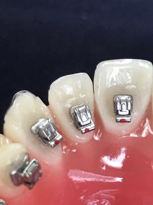 Klinik Molarröhrchen Zahnsprachbracket für DTC Orthodontie Selbstbinden Bracket