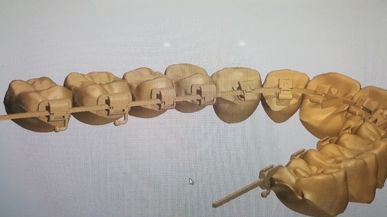 Leistungsstarke Maschinenquelle DTC Orthodontie Zungenbefestigungen mit selbstbindenden Klammern