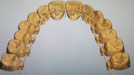Leistungsstarke Maschinenquelle DTC Orthodontie Zungenbefestigungen mit selbstbindenden Klammern